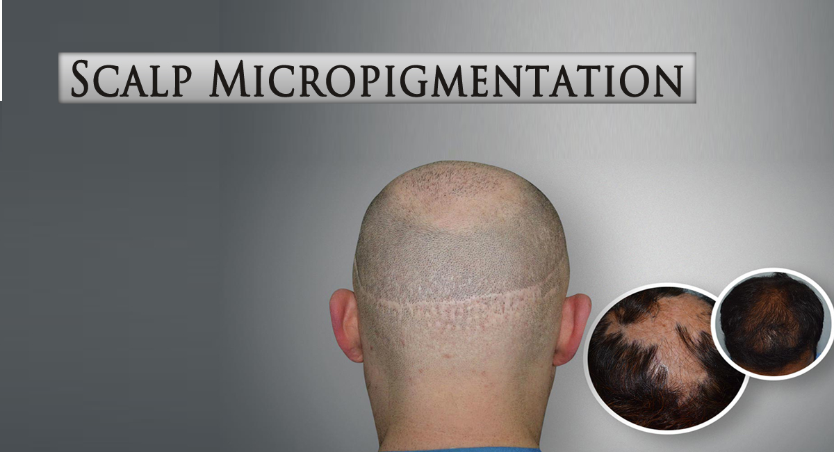 scalp micropigmentation- Get A Brief Knowledge of Scalp Micropigmentation