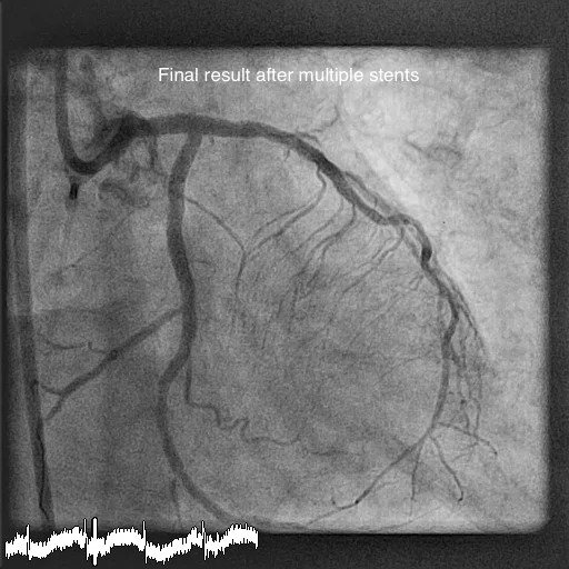 Long Term Outcome After Rotablation For Bail-out In Severely Calcified Coronary Lesions