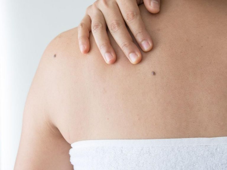 The Top 5 Myths Associated with Mole Check