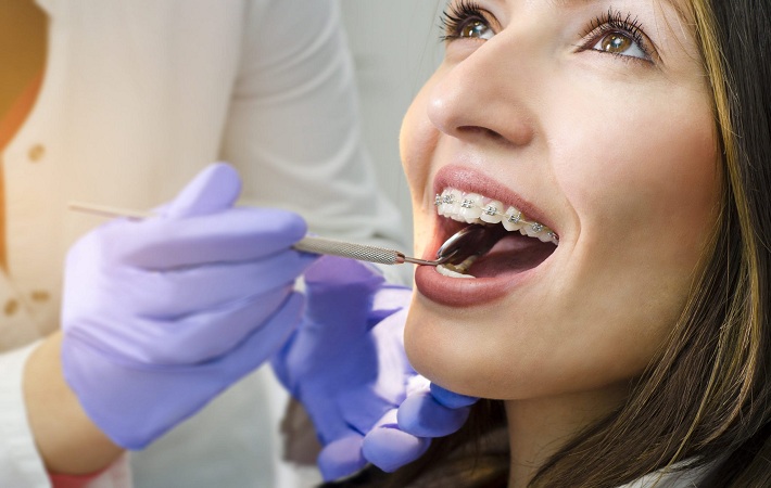 When Should You Consult an Orthodontist for Adult Braces?