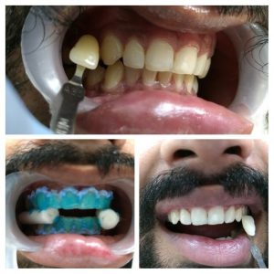 teeth whitening in gurgaon