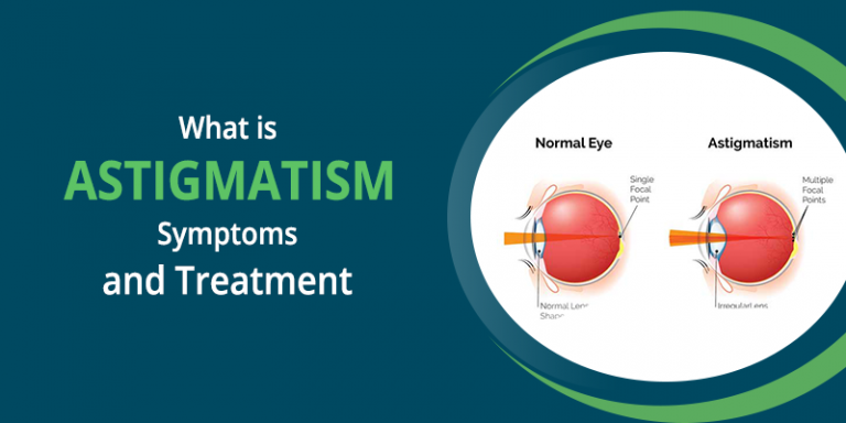 What is Astigmatism: Symptoms and Treatment