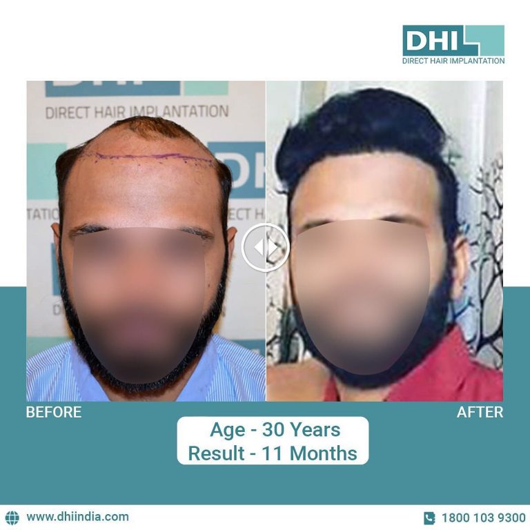 Why Should People Use Hair Transplant In Chandigarh?