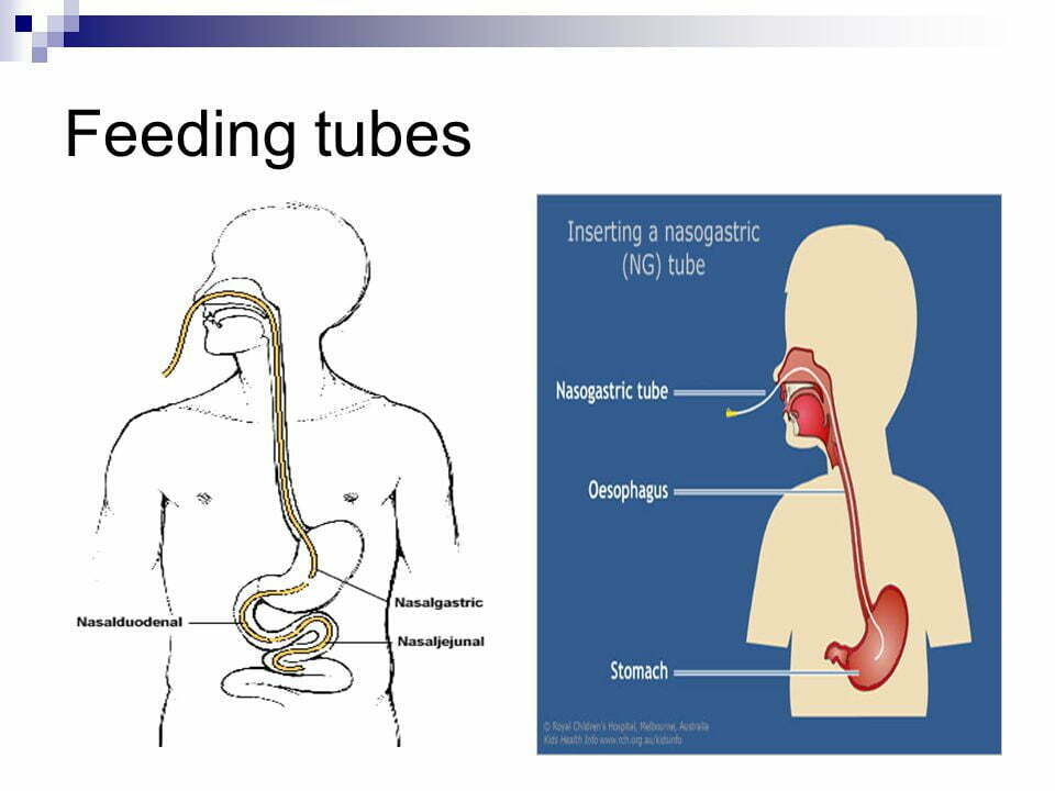 Benefits Of Feeding Tubes for Seniors