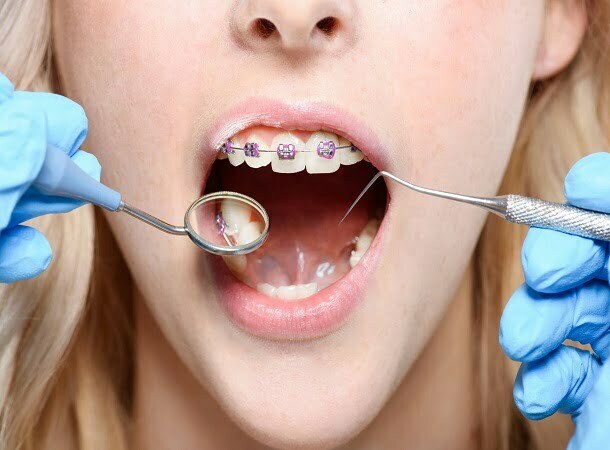 Best Orthodontist Melbourne
